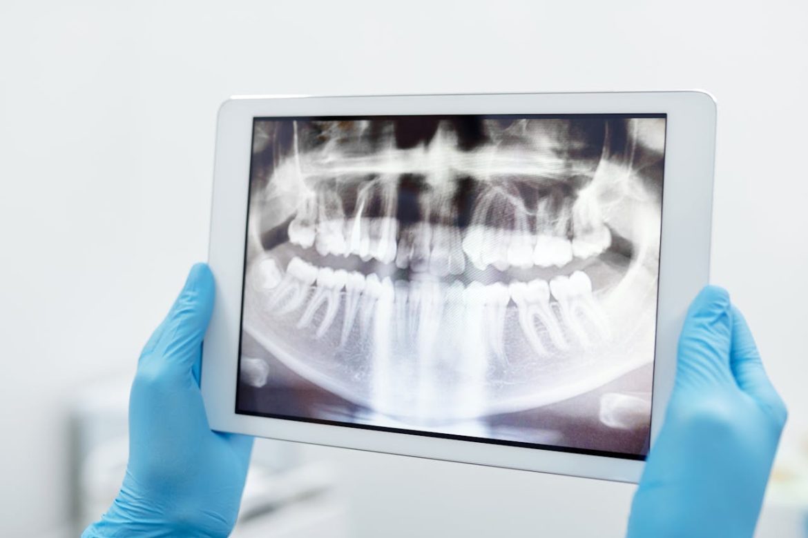 Blood thinners and dental procedures