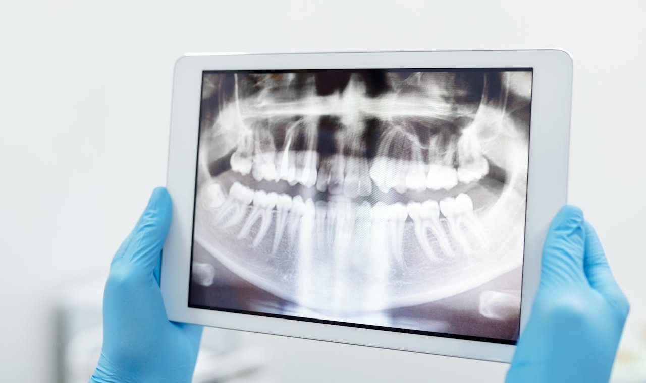 Blood thinners and dental procedures