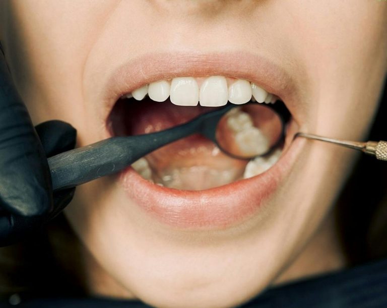 Flovent and oral thrush