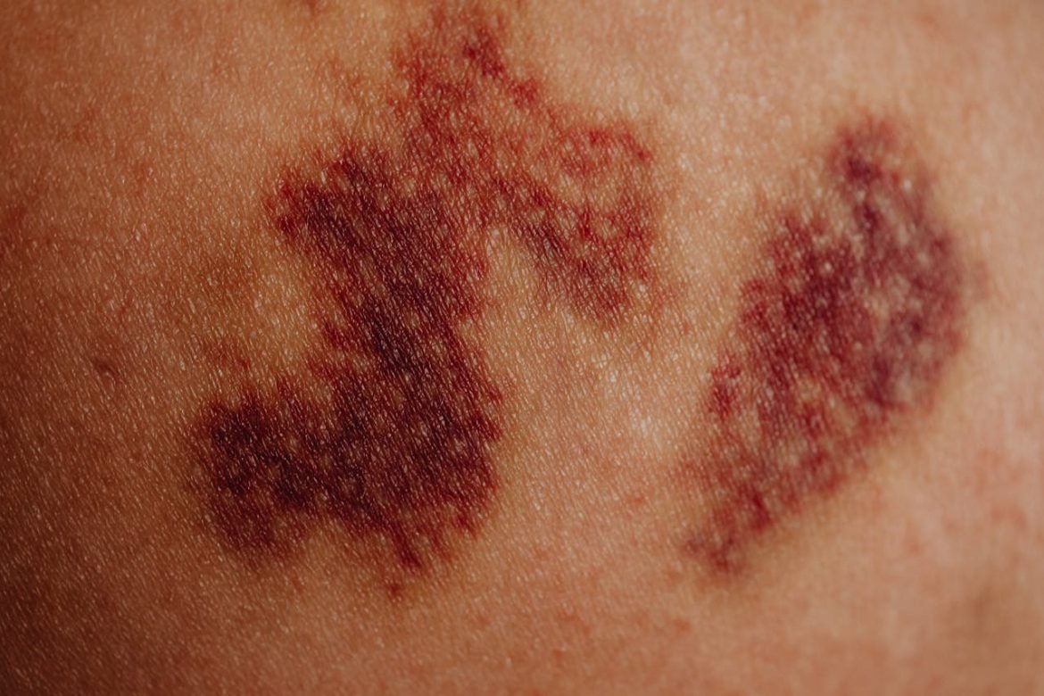 Xarelto bleeding prevention