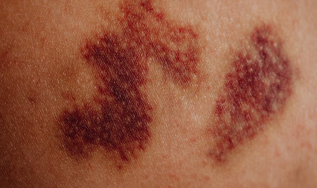 Xarelto bleeding prevention